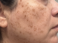 AGE SPOTS & SUN DAMAGE