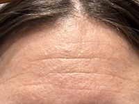 DEEP FOREHEAD WRINKLES