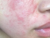 Damaged / Broken Skin Barrier