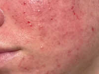 Post-Procedure Recovering Skin