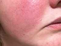 Red, Irritated & Itchy Skin