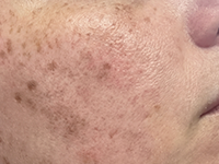 Dark Spots & Hyperpigmentation