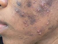Post-blemish discoloration 