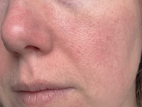 Dull, Lifeless & Tired-looking Skin
