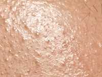 Clogged Pores & Surface Bumps