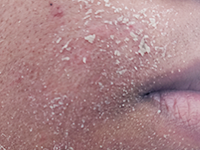 Dry, Peeling & Flaky Skin