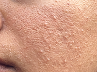 Rough, Textured & Dull Skin