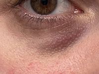 Dark, Shadowy Under-Eyes
