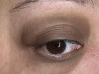 Darkened, Discoloured Eyelids