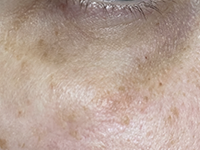 Eye-Area Pigmentation