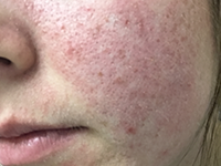 Dull, Lifeless, Blotchy Skin