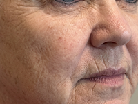 Deep Wrinkles & Mature Ageing Signs