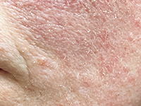 Dry, Flaky Skin Barrier