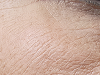 Fine Lines & Crepey Skin Texture