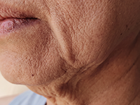 Saggy Skin Lacking Collagen