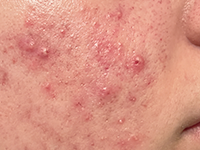 Active Breakouts & Flareups