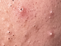 Blackheads & Whiteheads