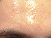 Excessive Oiliness & Shine