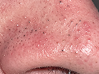 Blackheads & Whiteheads