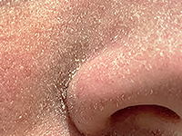Debris & Dead Skin Buildup
