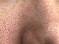 Enlarged, Visible, Stretched Pores