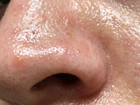 Excessive Oil & T-Zone Shine
