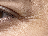 Deep Crow's Feet Wrinkles