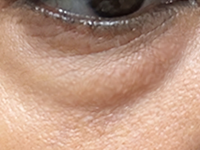 Puffy, Under-Eye Bags