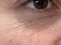 Fine Lines & Surface Creases