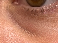 Noticeable Tear Troughs