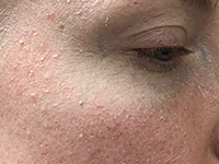 Dry & Dehydrated Skin