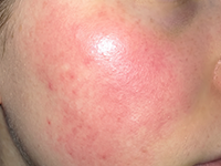 Tightness, Redness & Irritation